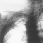 Image E. Pt DM Primary aspergillus pneumonia - needle biopsy (reverse image) (22.2.99)