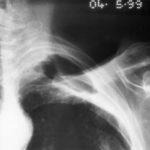 Image F. pt. DM Primary Aspergillus pneumonia (4.5.99)