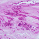 Image E. Histology of the infected nail (PAS stain) showing thick fungal elements and septate hyphae within nail material.