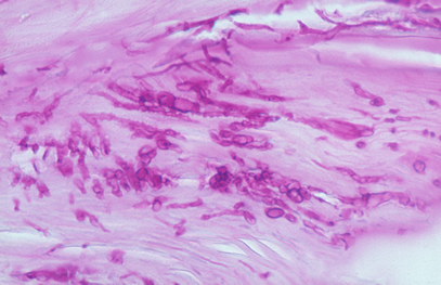 Image E. Histology of the infected nail (PAS stain) showing thick fungal elements and septate hyphae within nail material.