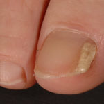 Image D. A case of onychomycosis associated with Aspergillus ochraceopetaliformis