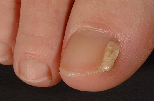 Image D. A case of onychomycosis associated with Aspergillus ochraceopetaliformis