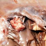 Image C. Mitral valve endocarditis, pt DB