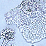 Image B. Wet mount microscopy of a skin scrape showing fungal fruiting head- suggestive of Aspergillus species