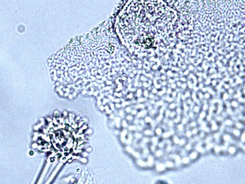 Image B. Wet mount microscopy of a skin scrape showing fungal fruiting head- suggestive of Aspergillus species