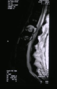 MR image of lower thoracic and upper lumbar spine showing involvement of L1 and T12 by osteomyelitis, subsequently proven to be due to Aspergillus.
