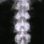 AP plain radiograph of upper lumbar, lower thoracic spine not demonstrating any discernable abnormality.