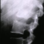 Lateral plain radiograph of T12-L2 showing increased intensity of the upper part of L2 and L1, with preservation of intervertebral disc spaces.