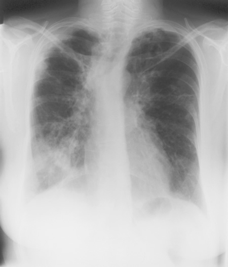 Image G. 19/7/93 Asthma with bronchiectasis and ABPA, with now overt chronic cavitary pulmonary aspergillosis (CCPA), bilaterally Chest x-ray showing extensive shadowing at the right base consistent with a chest infection or plugging, ring shadows and coarse markings throughout the lung fields consistent with bronchiectasis and right apical pleural thickening which has progressed. 