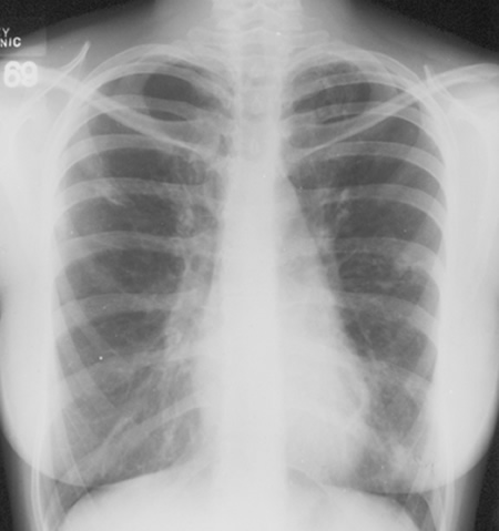 Image B. 4/3/69 Asthma with bronchiectasis.