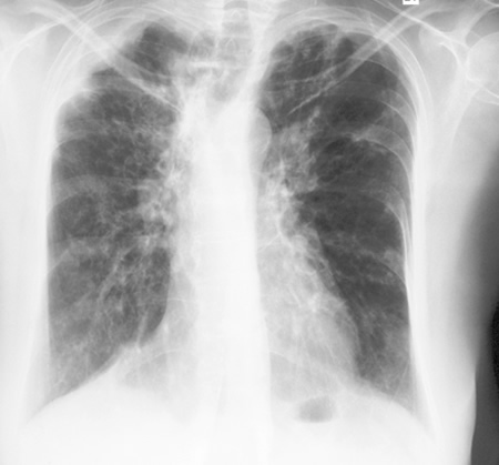 Image J. 11/10/02 Asthma with bronchiectasis, ABPA and CCPA which has progressed. 