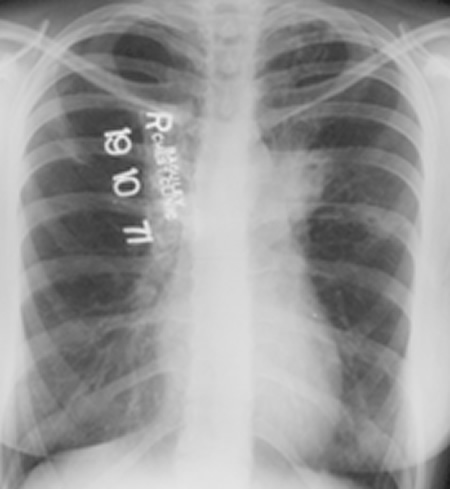 Image C. 19/10/71 Asthma with bronchiectasis.
