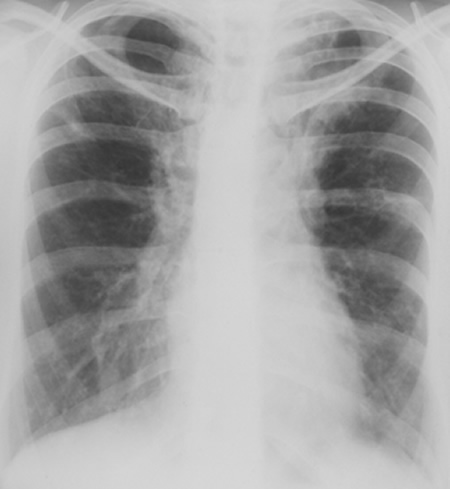 Image D. 22/9/81 Asthma with bronchiectasis and first radiological clue of ABPA.