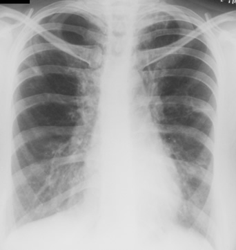 Image E. 3/11/81 Asthma with bronchiectasis and first radiological clue of ABPA.