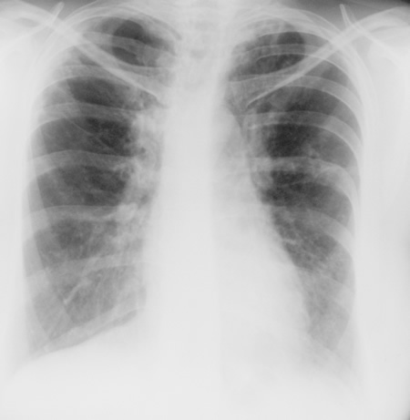Image F. 17/9/85 Asthma with bronchiectasis and ABPA, with first clue of chronic cavitary pulmonary aspergillosis (CCPA). 