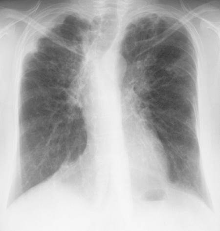 Image I 08/03/99 Asthma with bronchiectasis, ABPA and CCPA with obvious progression of bronchiectasis, and ? ABPA-related collapse left side Chest x-ray showing marked scoliosis, stable mild left upper lobe fibrosis and cavity formation, and stable right upper lobe pleural thickening.