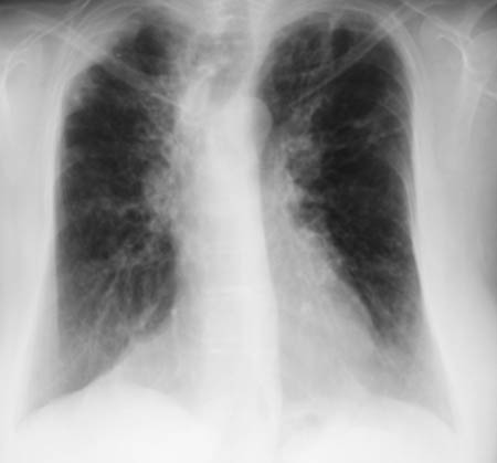 Image K. 05/04/04 Asthma with bronchiectasis, ABPA and CCPA with large airway disease of uncertain cause.  