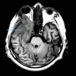 Image B MRI (T1-weighted, transversal view). The blue pointer shows progression of inflammatory tissue into the brain. The green pointer shows involvement of the lateral group of external ocular muscles.