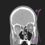 Image C CT scan image (bone window, coronal view) demonstrating destruction of the inferior wall of the right orbit.