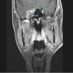 Image E MRI (T1-weighted, contrast-enhanced, coronal view). The pointers show pathological tissue in the right cavernous sinus (blue) and pathological enhancement of the right optical nerve (green).