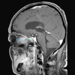Image F MRI (T1-weighted, contrast-enhanced, sagittal view). The pointers show pathological tissue in the right orbit (blue) with protrusion into the right optical canal (green).