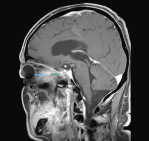 Image F MRI (T1-weighted, contrast-enhanced, sagittal view). The pointers show pathological tissue in the right orbit (blue) with protrusion into the right optical canal (green).