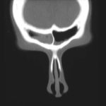 Patient AW Nasal polyposysis with asthma and sensitivity to aspergillus.