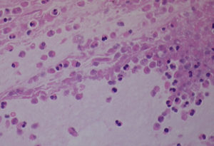 Image E. Mucous plug shows layering with eosinophilic debris and crystals (Images F & G). Plug has appearance of allergic mucin.
