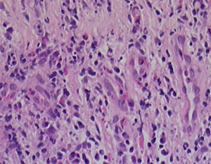 Image B. Evidence of squamous metaplasia with reactive atypia. There is no evidence of granulomatous inflammation or malignancy. Congo red and Grocott stain revealed no fungal elements.