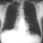 Image A. Chest X ray -normal (9th Jan)