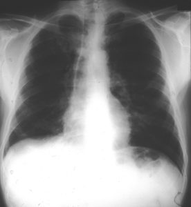 Image A. Chest X ray -normal (9th Jan)