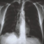 Image B. Chest X ray- over penetrated (28th Jan)