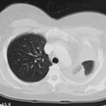 Image C. CT scan of the chest (Oct 04) shows extensive collapse of the left lung with only slight aeration of the left upper lobe. No definite central mass can be identified and no lymphadenopathy was visible. There is a small left sided pleural effusion. The right lung is normal. “The overall appearances remain highly suspicious of a central broncho-occlusive lesion on the left side.