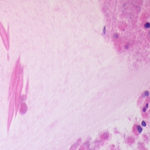 Image F. Mucous containing Charcot-Leyden crystals, stained with H & E