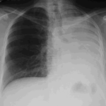 Image B. Progression of the process was documented in Dec (04) by chest x-ray, and bronchoscopy had not identified a malignant lesion. 