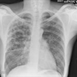 Pt DSM, Community acquired Aspergillus pneumonia 02/02/2010