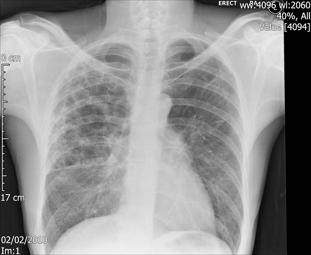 Pt DSM, Community acquired Aspergillus pneumonia 02/02/2010