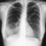 Image F. 03/01 Exacerbation showing shadowing in a different area of right lower lobe