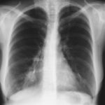 Image D. 01/98 Exacerbation showing right lower lobe opacification 