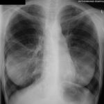 Chest Xray 19/09/06 Obvious enlargement and greater wall thickness of the ‘cysts’ in the left lower lobe, one with some fluid within it, with less evidence of a ‘cyst’ in the right lower lobe.