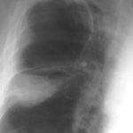Image D. 3/99 Note aspergilloma