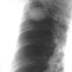 Image C. 6/97 Note aspergilloma