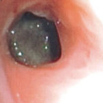 Fig 4 Aspergilloma seen on bronchoscopy. 