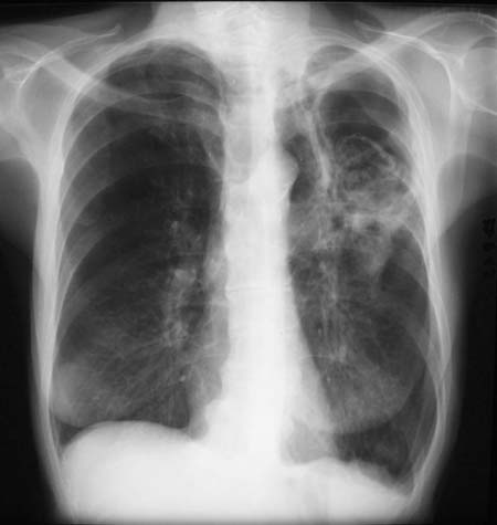 Chest x-ray from 23rd May 2003 showing a large left upper lobe cavity containing string-like material and balls and surrounded by additional cavities medially and inferiorly and surrounded by para-cavitary infiltrates.