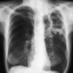 Chest x-ray from 9 th May 2003 showing a large left upper lobe cavity containing string-like material and balls and surrounded by additional cavities medially and inferiorly and surrounded by para-cavitary infiltrates.