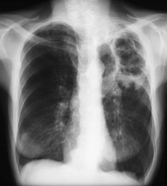 Chest x-ray from 9 th May 2003 showing a large left upper lobe cavity containing string-like material and balls and surrounded by additional cavities medially and inferiorly and surrounded by para-cavitary infiltrates.