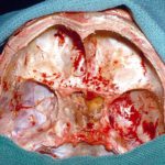 Base of skull at autopsy showing pus in the sphenoid sinus and destruction of the lateral wall of the sinus, as demonstrated on the CT scan.