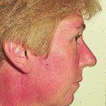 Patient AB: Voriconazole rash. Following 8 weeks of Voriconazole, patient had remarkable facial erythema, most consistent with sun exposure because of sparing of her neck.