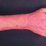 Forearm erythema related to voriconazole 2