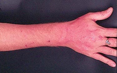 Forearm erythema related to voriconazole 2